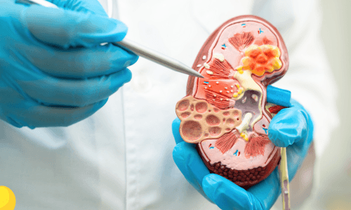 Laser Kidney Stone Treatment