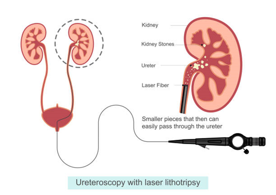  Ureteroscopy